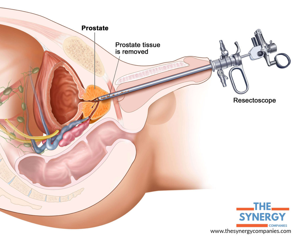 How Long after Prostate Surgery does Impotence Last